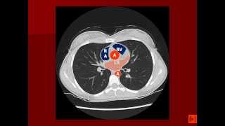 Normal Chest CT with labels [upl. by Retla]