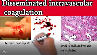 Disseminated intravascular coagulation DIC  Causes Symptoms Treatment and prognosis [upl. by Brill]