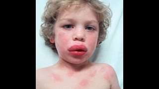 Anaphylaxis and Acute Allergic reaction  How to Help [upl. by Elsbeth]