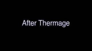 Thermage Side Affects  After Thermage Treatment [upl. by Annaigroeg]