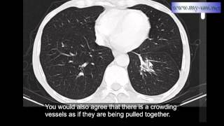 Rounded atelectasis  CT scan of Chest [upl. by Aicnom]