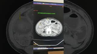 POLYPOIDAL LESION AND INTUSSUSCEPTION [upl. by Dyoll298]