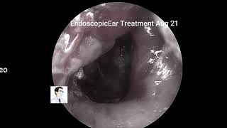 Treatment of recurrent external auditory canal cholesteatoma with otoendoscopy for 13 minutes [upl. by Nylemaj246]