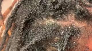 How to remove scalesdandruff or seborrheic dermatitis from the scalp [upl. by Ellerahc299]