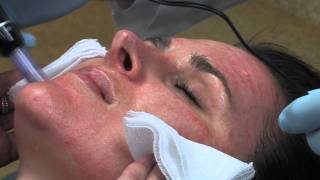 Dr Mark B Taylor Review of Dermapen Micro Needling  Gateway Aesthetics [upl. by Emelun]