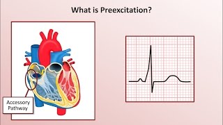 AV Nodal ReEntrant Tachycardia AVNRT  Pathophysiology Typical Versus Atypical ECG Diagnosis [upl. by Reamy]