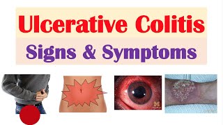 Ulcerative Colitis Pathophysiology Symptoms Risk factors Diagnosis and Treatments Animation [upl. by Columbus]