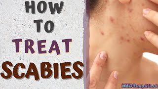 HOW TO TREAT SCABIESscabies treatment at home [upl. by Ecnerrat]