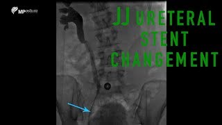 JJ ureteral stent changement [upl. by Odama]