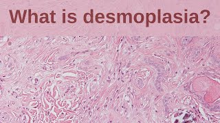 What is Desmoplasia  Pathology mini tutorial [upl. by Spalding]