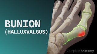 Bunion Hallux Valgus [upl. by Novej940]