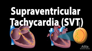 Supraventricular Tachycardia SVT PSVT Animation [upl. by Itin]