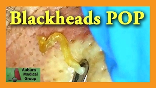 Blackheads POP  Auburn Medical Group [upl. by Aynekat]