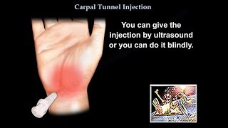 Carpal Tunnel Injection  Everything You Need To Know  Dr Nabil Ebraheim [upl. by Burrow]