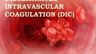 Disseminated Intravascular Coagulation [upl. by Gabi19]