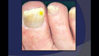 Toenail Debridement by a Podiatrist [upl. by Way248]