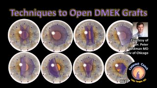 Complex Corneal Transplantation Cataract Surgery Synechialysis [upl. by Llertnauq]