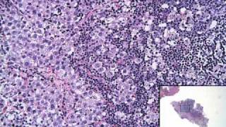 Surgical Pathology  Germinoma  UCLA Pituitary Tumor Program [upl. by Ellenrahc]