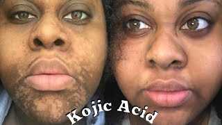 4 MONTHS KOJIC ACID EXPERIENCE \\ Sherelle Saint Rose [upl. by Cort832]