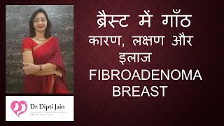 FIBROADENOMA BREAST ब्रैस्ट में गाँठ कारण लक्षण और इलाज  Dr Dipti Jain Ahmedabad [upl. by Adlare127]