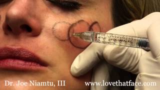 Juverderm Voluma 5 Minute Cheeks by Dr Joe Niamtu III [upl. by Kurtis]