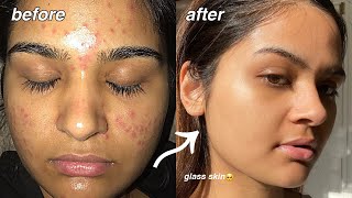 how i cleared my acne FOR GOOD something finally worked [upl. by Ahseer]