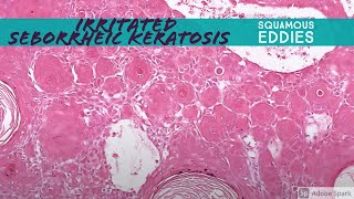 Irritated Seborrheic Keratosis squamous eddies 5Minute Pathology Pearls [upl. by Piderit]