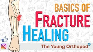 Fracture Healing  ANIMATION  BASICS  The Young Orthopod [upl. by Annirac]