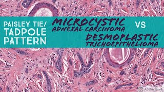 Microcystic Adnexal Carcinoma vs Desmoplastic Trichoepithelioma Paisley TieTadpole Pattern [upl. by Pinkerton]