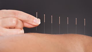 The Science Behind How Acupuncture Helps Relieve Pain A Doctor Of Chinese Medicine Explains [upl. by Bigot]