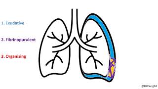 Empyema and Pleural Effusions [upl. by Aicenra]