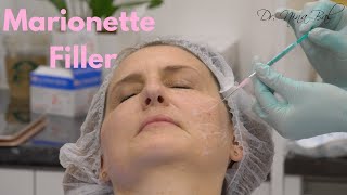 Filler Marionette Lines Before and After 💕 Dr Nina Bal 💕 Facial Sculpting [upl. by Erving203]