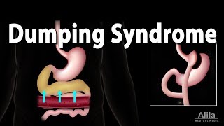 Dumping Syndrome Animation [upl. by Anidam824]