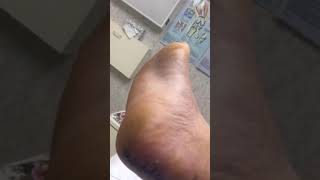 Day 11 Part 2  Achilles Heel spur surgery  stitches revealed [upl. by Buddie]