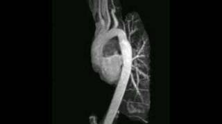 Coronary artery anatomy  Coronary angiogram [upl. by Ettennyl]