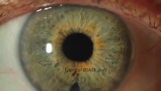 Fuchs Dystrophy amp Corneal Edema [upl. by Tisha]