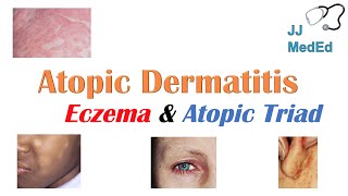 Eczema Atopic Dermatitis  Atopic Triad Triggers Who gets it Why does it happen amp Treatment [upl. by Photima]