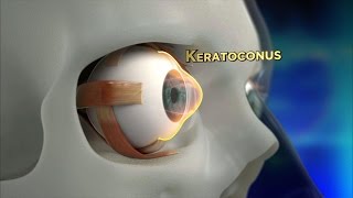 Keratoconus Procedure Explained [upl. by Joly]