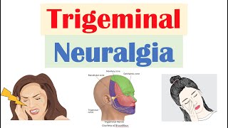 Trigeminal Neuralgia “Severe Facial Pain” Causes Pathophysiology Symptoms Diagnosis Treatment [upl. by Sumedocin]