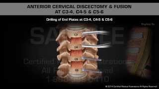 Anterior Cervical Discectomy amp Fusion at C34 C45 amp C56 [upl. by Levitan]