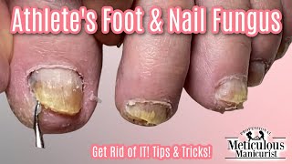 Reverse Nail Fungus Caused by Athletes Feet [upl. by Aya811]