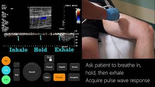 Ultrasound Tutorial DVT  Lower Limb Veins  Radiology Nation [upl. by Retla]