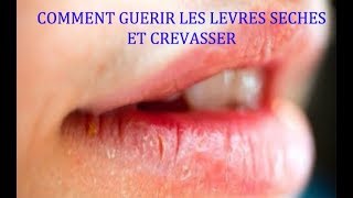 COMMENT SOIGNER LES LÈVRES SÈCHES ET CREVASSER [upl. by Aciraj]