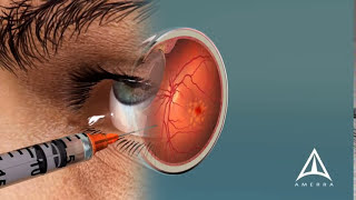 Retinoschisis Serous Macular Detachment [upl. by Dranoel]