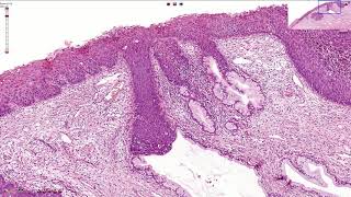 Understanding HPV What You Need to Know [upl. by Lucho]