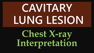 Cavitary Lung Lesion  Chest Xray Interpretation [upl. by Asaert469]