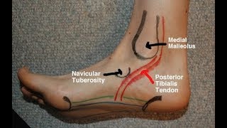 Posterior Tibial Tendinitis Evaluation with Paul Marquis PT [upl. by Suiddaht988]