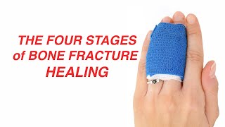 Fracture Healing  Everything You Need To Know  Dr Nabil Ebraheim [upl. by Annasiul]