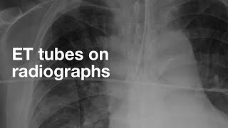 ETT Cuff Pressure CheckAssessment [upl. by Ahsitam]