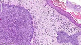 Basal Cell Carcinoma Including Variants  Histopathology [upl. by Madelina]